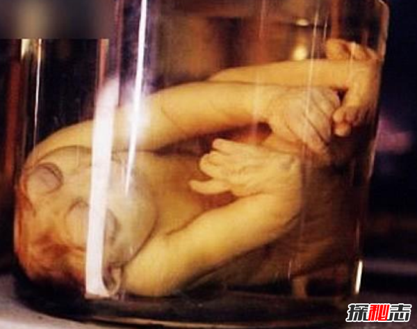 美國穆特博物館肥皂女尸,重口味分分鐘想吐(腐爛女尸成肥皂)