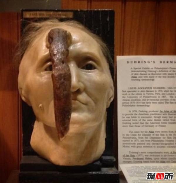 美國穆特博物館肥皂女尸,重口味分分鐘想吐(腐爛女尸成肥皂)