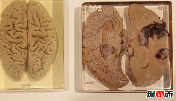 美國穆特博物館肥皂女尸,重口味分分鐘想吐(腐爛女尸成肥皂)