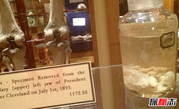 美國穆特博物館肥皂女尸,重口味分分鐘想吐(腐爛女尸成肥皂)