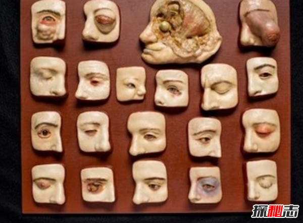 美國穆特博物館肥皂女尸,重口味分分鐘想吐(腐爛女尸成肥皂)