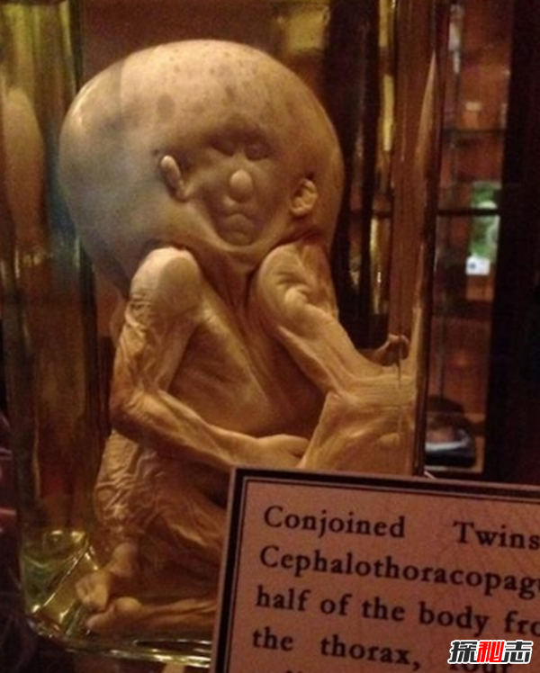 美國穆特博物館肥皂女尸,重口味分分鐘想吐(腐爛女尸成肥皂)