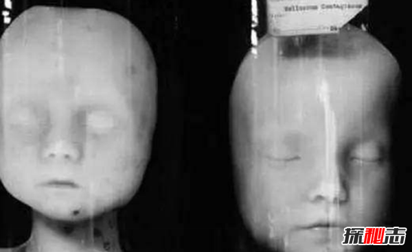 美國穆特博物館肥皂女尸,重口味分分鐘想吐(腐爛女尸成肥皂)