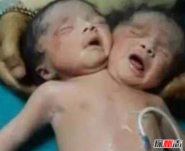 美國穆特博物館肥皂女尸,重口味分分鐘想吐(腐爛女尸成肥皂)