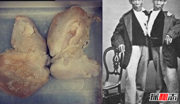 美國穆特博物館肥皂女尸,重口味分分鐘想吐(腐爛女尸成肥皂)