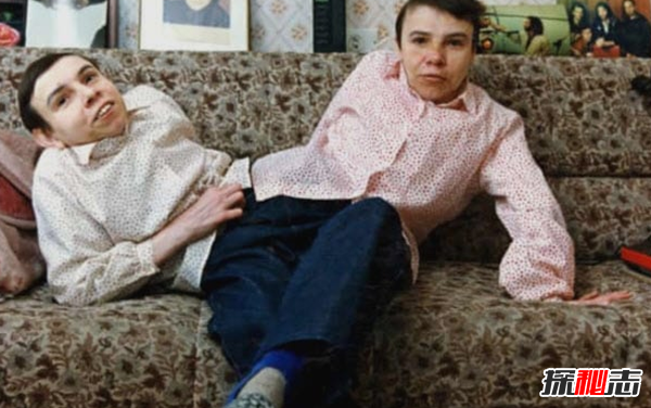 關(guān)于連體雙胞胎的十大心酸事實(shí)