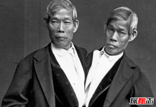 關(guān)于連體雙胞胎的十大心酸事實(shí)