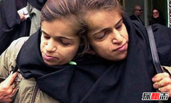 關(guān)于連體雙胞胎的十大心酸事實(shí)