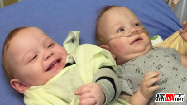 關(guān)于連體雙胞胎的十大心酸事實(shí)