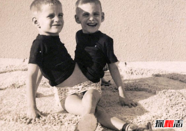 關(guān)于連體雙胞胎的十大心酸事實(shí)