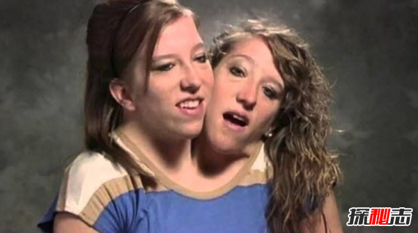 關(guān)于連體雙胞胎的十大心酸事實(shí)