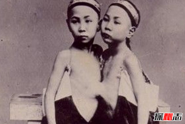 關(guān)于連體雙胞胎的十大心酸事實(shí)