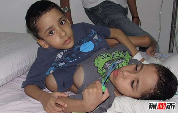 關(guān)于連體雙胞胎的十大心酸事實(shí)