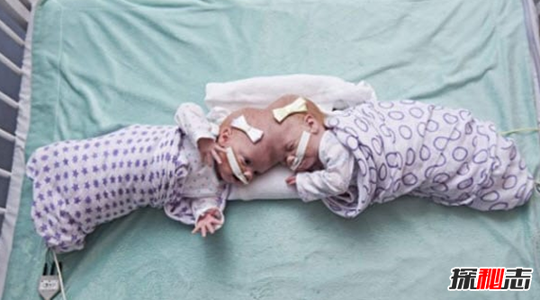 關(guān)于連體雙胞胎的十大心酸事實(shí)