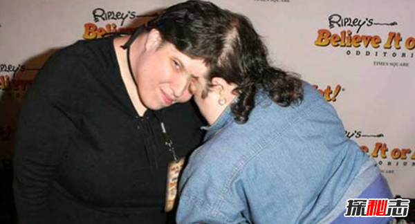 關(guān)于連體雙胞胎的十大心酸事實(shí)