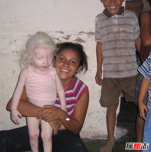 白化病是怎么引起的?關(guān)于白化病的15個(gè)驚人事實(shí)