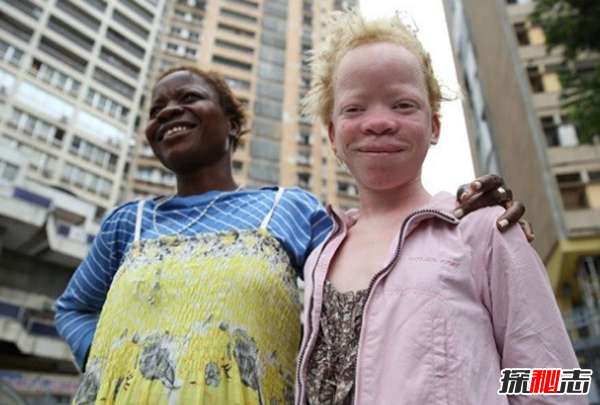 白化病是怎么引起的?關(guān)于白化病的15個(gè)驚人事實(shí)