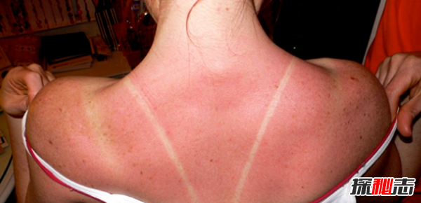 白化病是怎么引起的?關(guān)于白化病的15個(gè)驚人事實(shí)