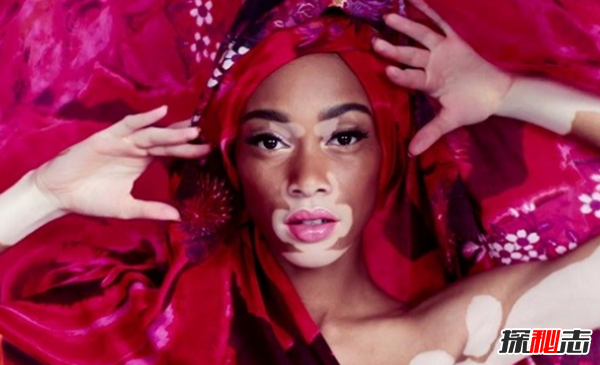 白化病是怎么引起的?關(guān)于白化病的15個(gè)驚人事實(shí)