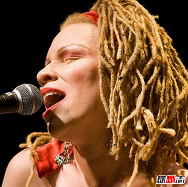 白化病是怎么引起的?關(guān)于白化病的15個(gè)驚人事實(shí)