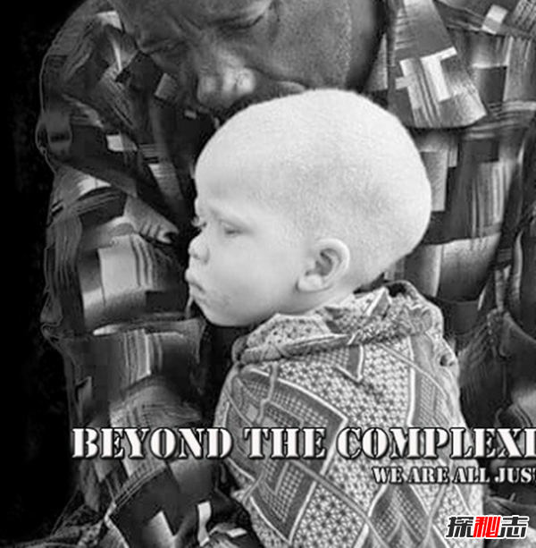 白化病是怎么引起的?關(guān)于白化病的15個(gè)驚人事實(shí)