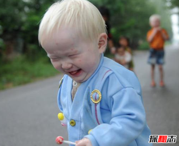 白化病是怎么引起的?關(guān)于白化病的15個(gè)驚人事實(shí)