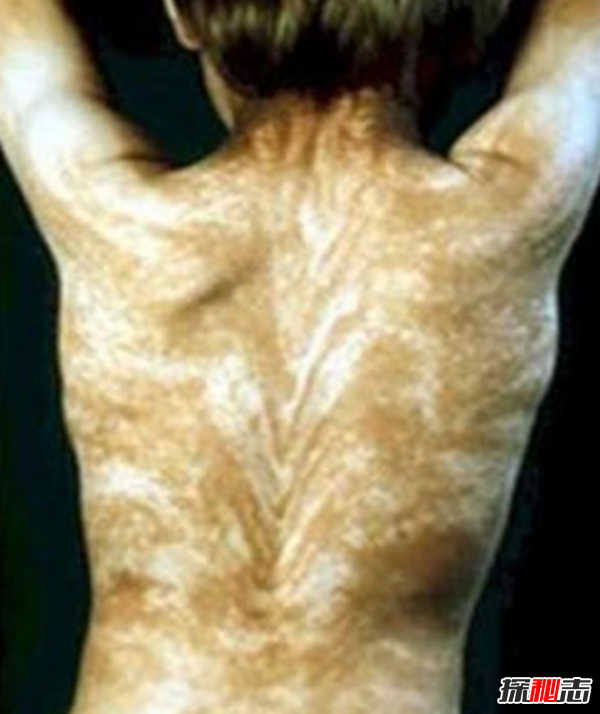 Blaschko斑紋癥是什么?全身長(cháng)滿(mǎn)條紋的罕見(jiàn)怪病