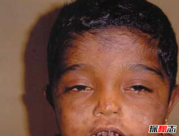 Blaschko斑紋癥是什么?全身長(cháng)滿(mǎn)條紋的罕見(jiàn)怪病