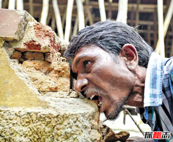 Blaschko斑紋癥是什么?全身長(cháng)滿(mǎn)條紋的罕見(jiàn)怪病