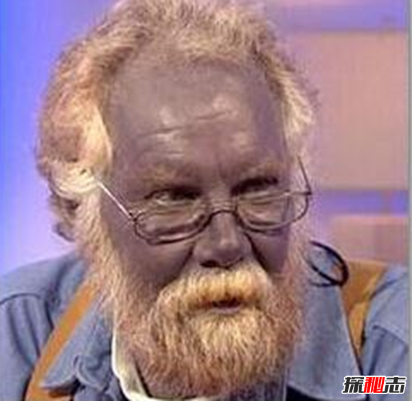 Blaschko斑紋癥是什么?全身長(cháng)滿(mǎn)條紋的罕見(jiàn)怪病