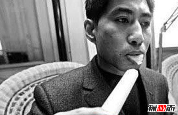 Blaschko斑紋癥是什么?全身長(cháng)滿(mǎn)條紋的罕見(jiàn)怪病