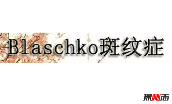 Blaschko斑紋癥是什么?全身長(cháng)滿(mǎn)條紋的罕見(jiàn)怪病