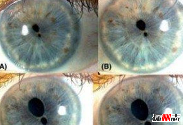 什么是雙瞳孔?世界上有雙瞳孔的人嗎?(中國史書(shū)記載共八人)