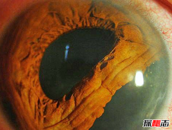 什么是雙瞳孔?世界上有雙瞳孔的人嗎?(中國史書(shū)記載共八人)