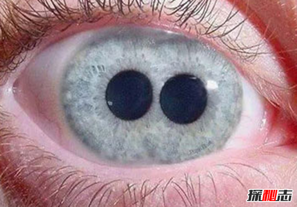 什么是雙瞳孔?世界上有雙瞳孔的人嗎?(中國史書(shū)記載共八人)