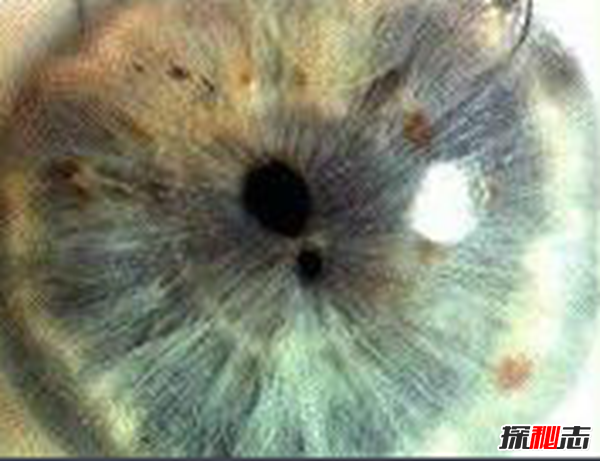 什么是雙瞳孔?世界上有雙瞳孔的人嗎?(中國史書(shū)記載共八人)