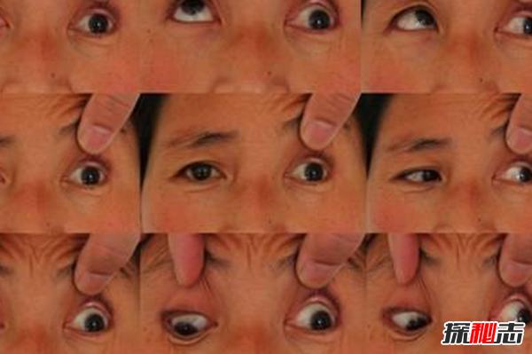 什么是雙瞳孔?世界上有雙瞳孔的人嗎?(中國史書(shū)記載共八人)