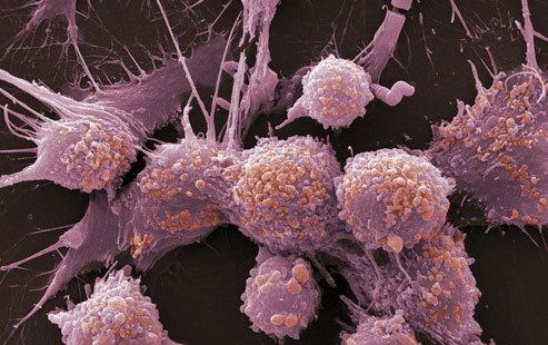 十大最痛苦癌癥排行：第九與吃有關(guān),第一個(gè)男性最怕