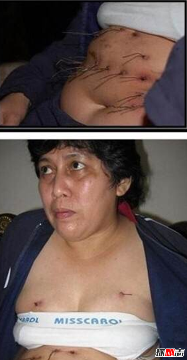 世界上科學(xué)解釋不了的事,印尼女子一夜長(cháng)出10公分鐵絲