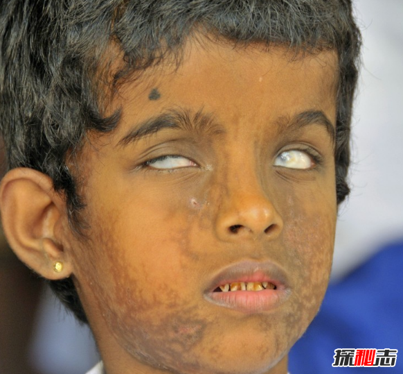 世界上稀有的銀眼睛人：盲人屬于其中一種