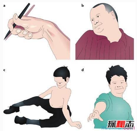 中國世界首例舞蹈豬,亨廷頓氏舞蹈癥是什么??？