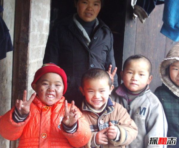 卟啉病為什么要喝血?卟啉病真實(shí)患者圖片(吸血鬼的原型病)