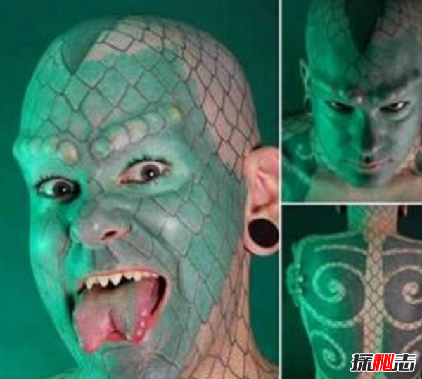 卟啉病為什么要喝血?卟啉病真實(shí)患者圖片(吸血鬼的原型病)