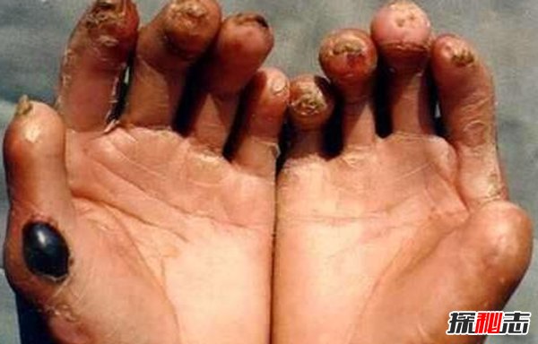 卟啉病為什么要喝血?卟啉病真實(shí)患者圖片(吸血鬼的原型病)