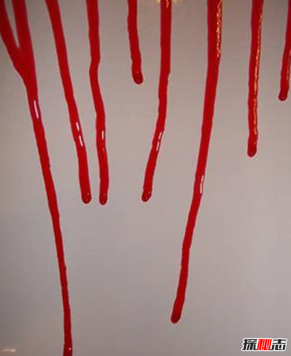 卟啉病為什么要喝血?卟啉病真實(shí)患者圖片(吸血鬼的原型病)