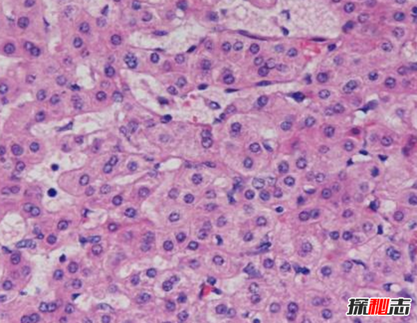 卟啉病為什么要喝血?卟啉病真實(shí)患者圖片(吸血鬼的原型病)