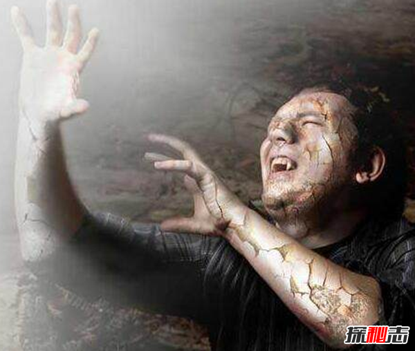 卟啉病為什么要喝血?卟啉病真實(shí)患者圖片(吸血鬼的原型病)