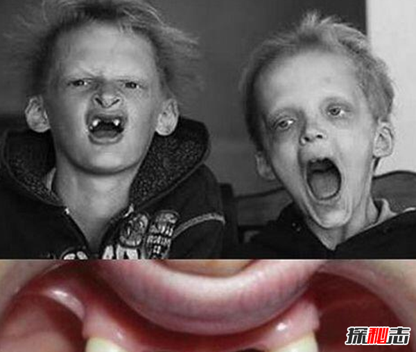 卟啉病為什么要喝血?卟啉病真實(shí)患者圖片(吸血鬼的原型病)