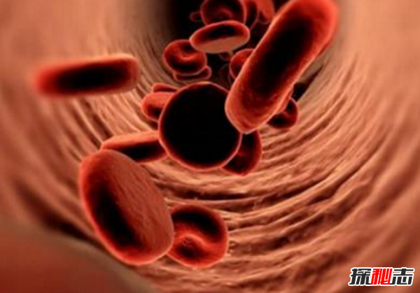 卟啉病為什么要喝血?卟啉病真實(shí)患者圖片(吸血鬼的原型病)