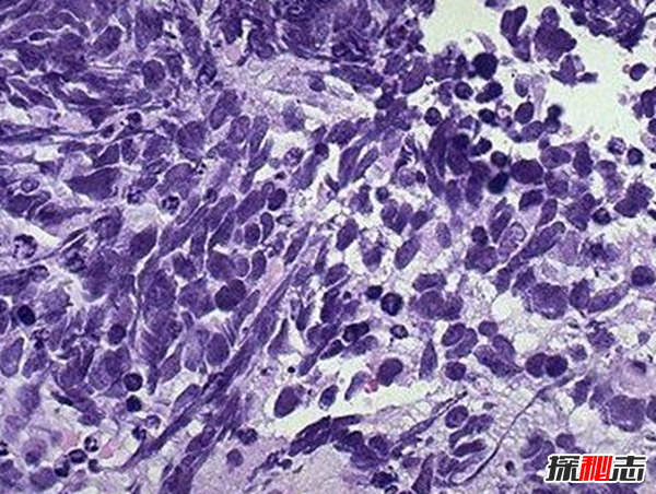 卟啉病為什么要喝血?卟啉病真實(shí)患者圖片(吸血鬼的原型病)